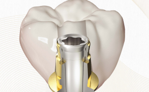 展开修复之翼：韩国种植牙品牌柯威尔推出SFIT无粘接种植系统
